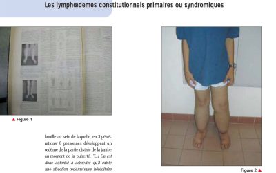 Les lymphoedèmes primaires