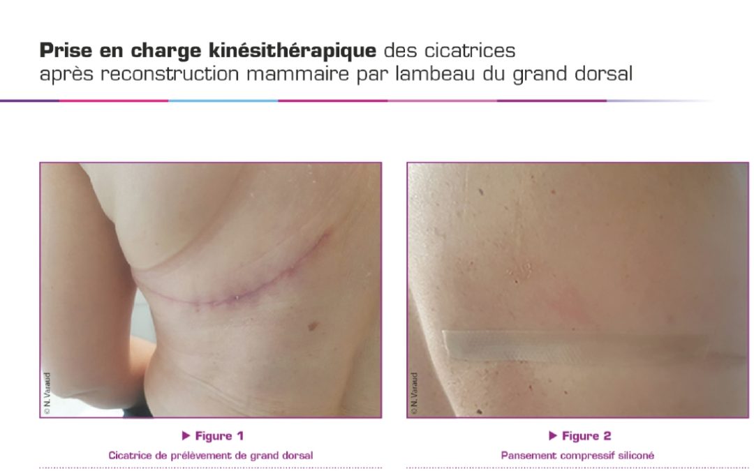 Traitement des cicatrices après lambeau du grand dorsal
